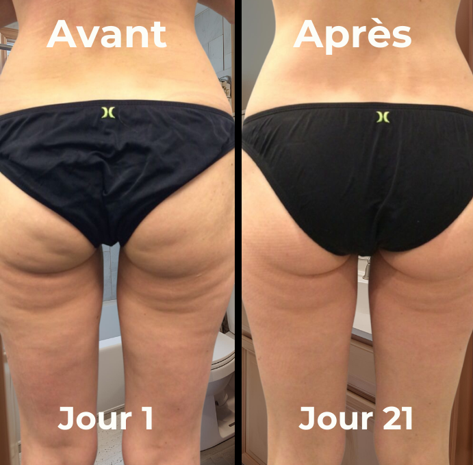 Masseur anti-cellulite skin