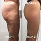 Masseur anti-cellulite skin