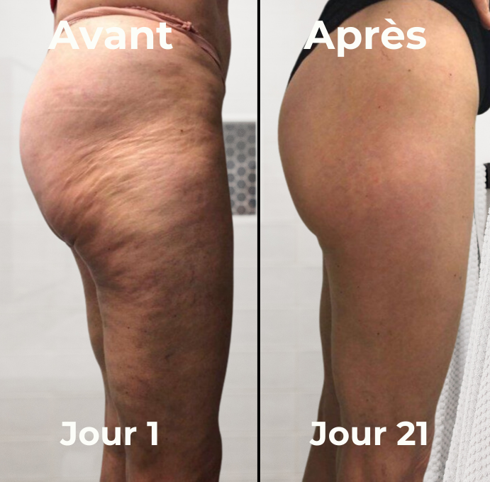 Masseur anti-cellulite skin